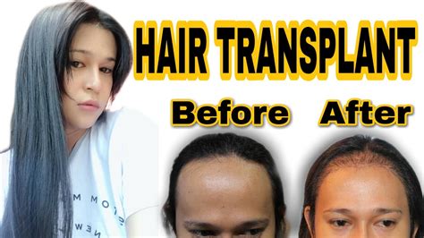 hair transplant philippines review